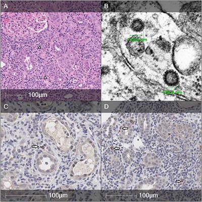 Case Report: SARS-CoV-2 Associated Acute Interstitial Nephritis in an Adolescent